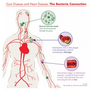 periodontitis heart disease