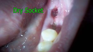 Dry Socket