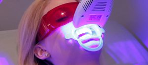 Teeth whitening