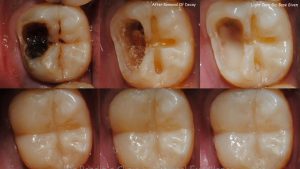 Types of Dental Decay