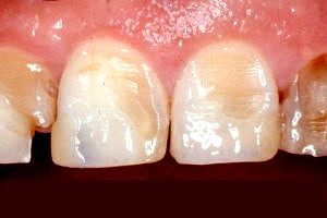 Dental erosion