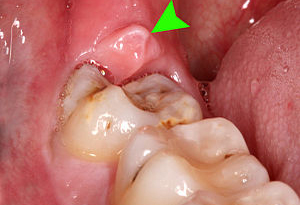 Myths of the extraction of Wisdom teeth