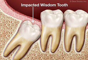 Myths of the extraction of Wisdom Teeth