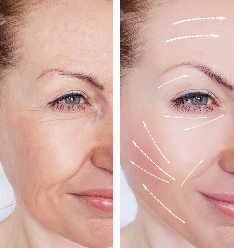 Wrinkle Reduction